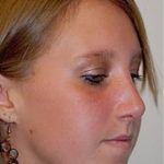 Rhinoplasty Before & After Patient #1545