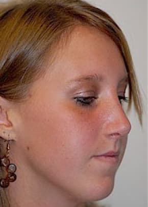 Rhinoplasty Before & After Patient #1545