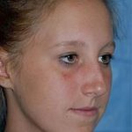 Rhinoplasty Before & After Patient #1545