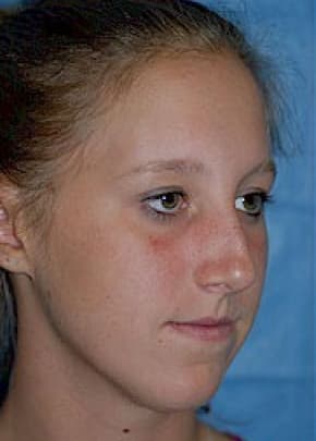 Rhinoplasty Before & After Patient #1545