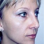 Rhinoplasty Before & After Patient #1544