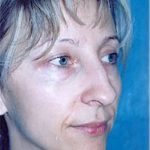 Rhinoplasty Before & After Patient #1544