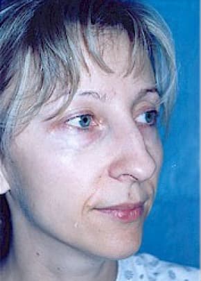 Rhinoplasty Before & After Patient #1544