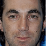 Rhinoplasty Before & After Patient #1543