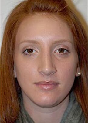 Rhinoplasty Before & After Patient #1542