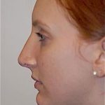 Rhinoplasty Before & After Patient #1542