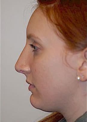 Rhinoplasty Before & After Patient #1542