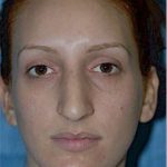 Rhinoplasty Before & After Patient #1542