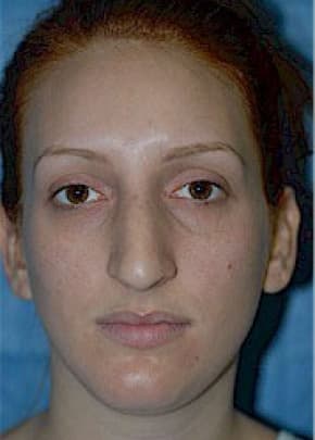 Rhinoplasty Before & After Patient #1542