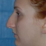 Rhinoplasty Before & After Patient #1542