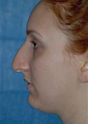 Rhinoplasty Before & After Patient #1542