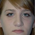 Rhinoplasty Before & After Patient #1541