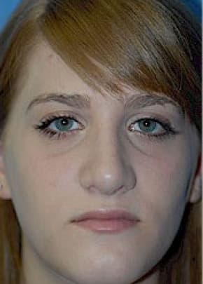 Rhinoplasty Before & After Patient #1541