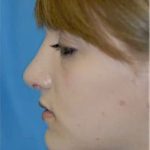 Rhinoplasty Before & After Patient #1541