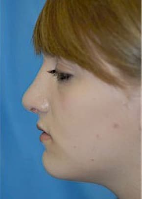 Rhinoplasty Before & After Patient #1541