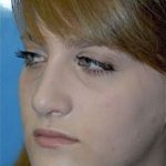 Rhinoplasty Before & After Patient #1541