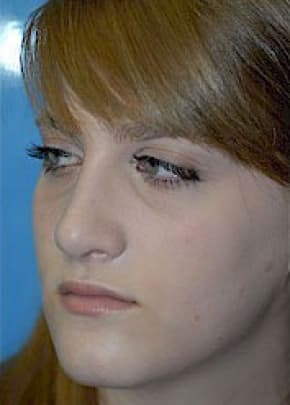 Rhinoplasty Before & After Patient #1541