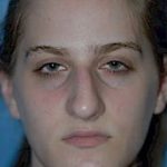 Rhinoplasty Before & After Patient #1541