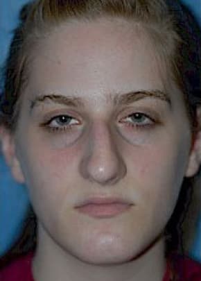 Rhinoplasty Before & After Patient #1541