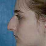 Rhinoplasty Before & After Patient #1541