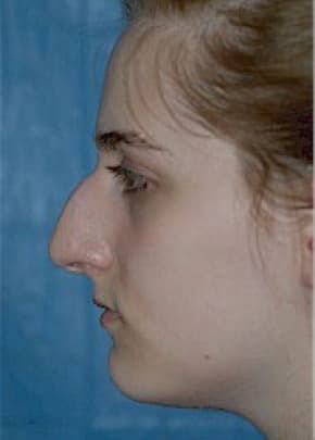 Rhinoplasty Before & After Patient #1541