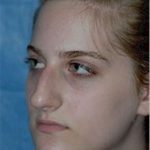 Rhinoplasty Before & After Patient #1541