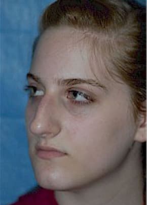 Rhinoplasty Before & After Patient #1541