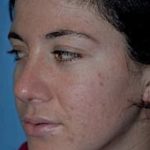 Rhinoplasty Before & After Patient #1540