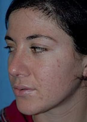 Rhinoplasty Before & After Patient #1540