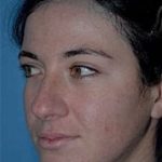 Rhinoplasty Before & After Patient #1540