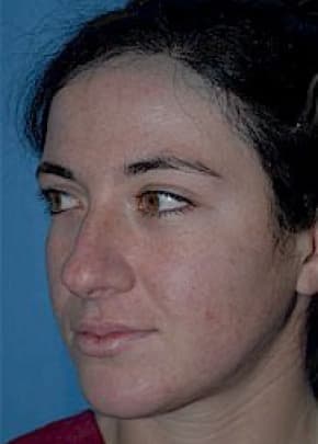 Rhinoplasty Before & After Patient #1540