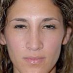 Rhinoplasty Before & After Patient #1539