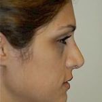 Rhinoplasty Before & After Patient #1537