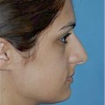 Rhinoplasty Before & After Patient #1537