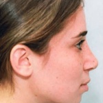 Rhinoplasty Before & After Patient #1536