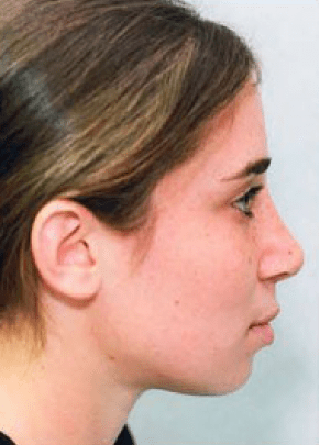 Rhinoplasty Before & After Patient #1536
