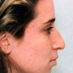 Rhinoplasty Before & After Patient #1536