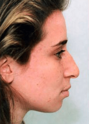 Rhinoplasty Before & After Patient #1536