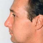Rhinoplasty Before & After Patient #1535