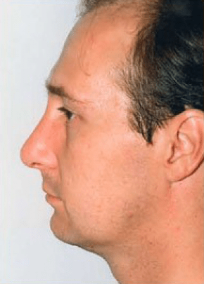 Rhinoplasty Before & After Patient #1535
