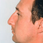 Rhinoplasty Before & After Patient #1535