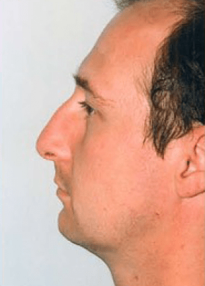 Rhinoplasty Before & After Patient #1535