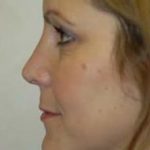 Rhinoplasty Before & After Patient #1534