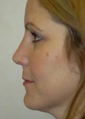 Rhinoplasty Before & After Patient #1534