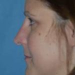 Rhinoplasty Before & After Patient #1534