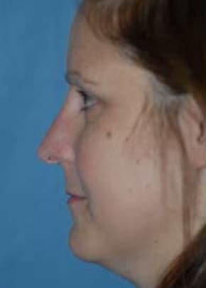 Rhinoplasty Before & After Patient #1534