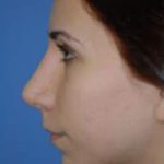 Rhinoplasty Before & After Patient #1533
