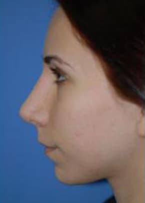 Rhinoplasty Before & After Patient #1533