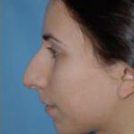 Rhinoplasty Before & After Patient #1533