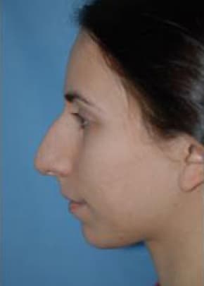 Rhinoplasty Before & After Patient #1533